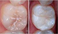 فیشورسیلانت دندان چیست؟