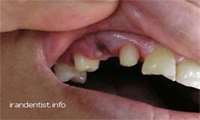 چرا پس از کشیدن دندان دچار درد شدید می شوید؟