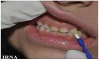 فلورایدتراپی تا 75 درصد در کاهش پوسیدگی دندان نقش دارد.