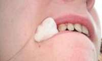 توصیه های بهداشتی بعداز کشیدن دندان 