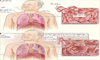 6 آذر (27 نوامبر) روز جهانی COPD 
